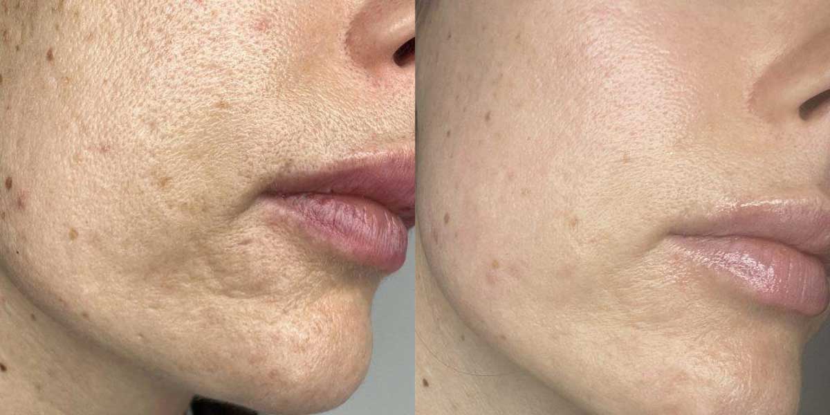 before-after-02