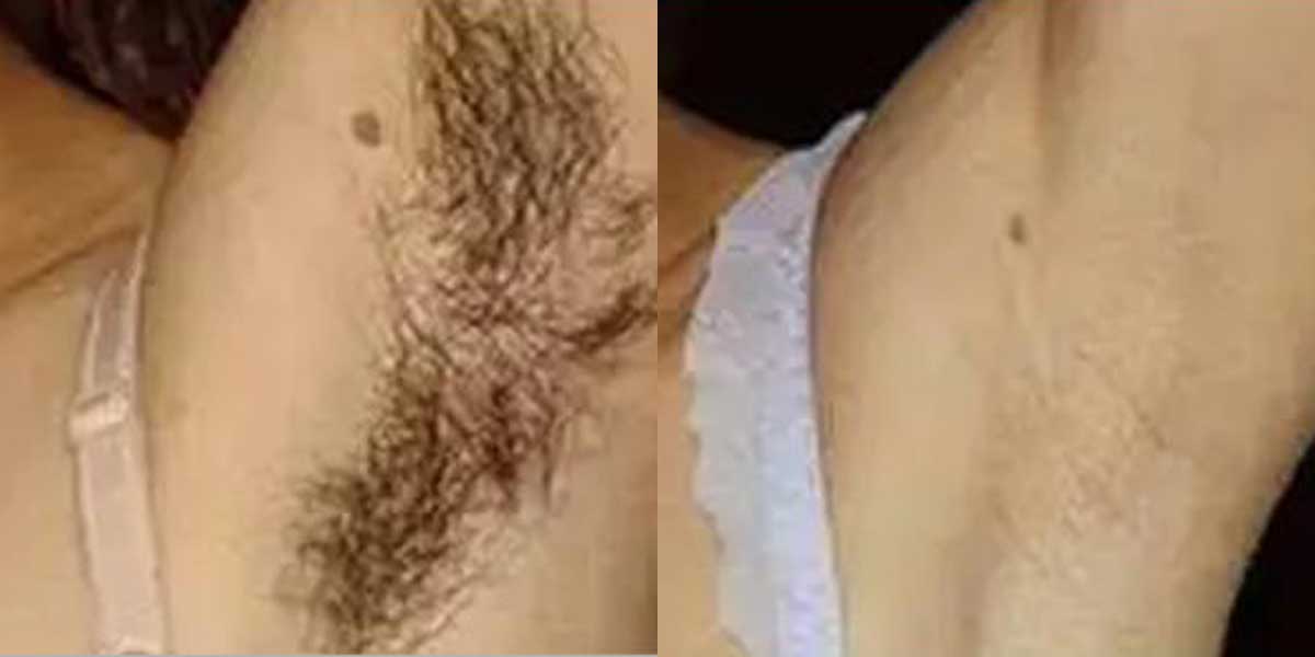 before-after-04