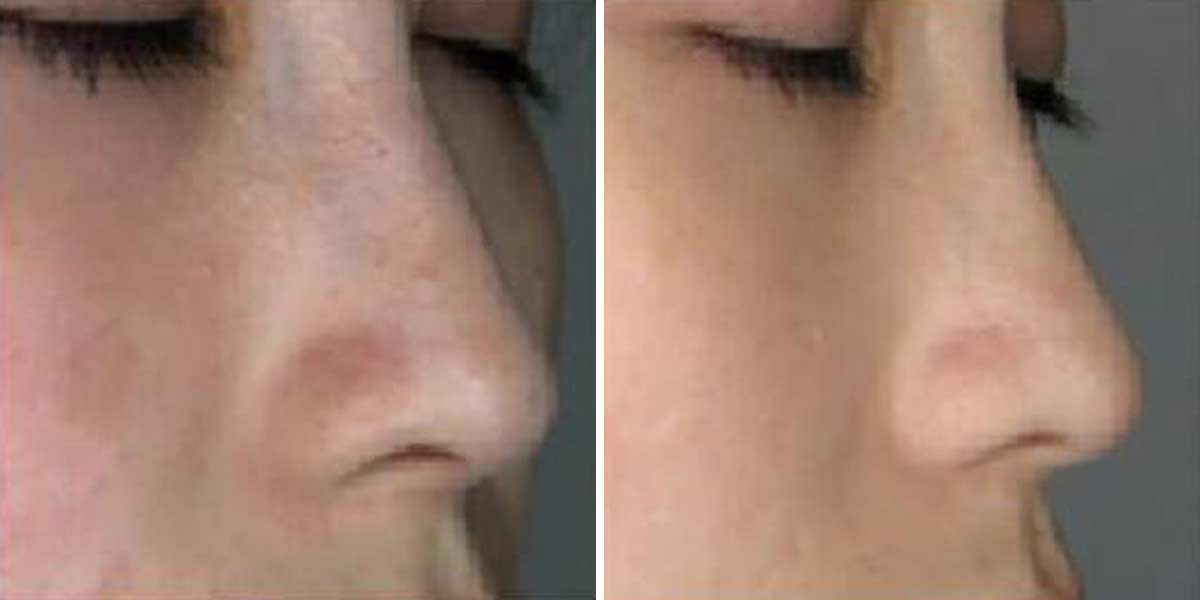 Before-After-01