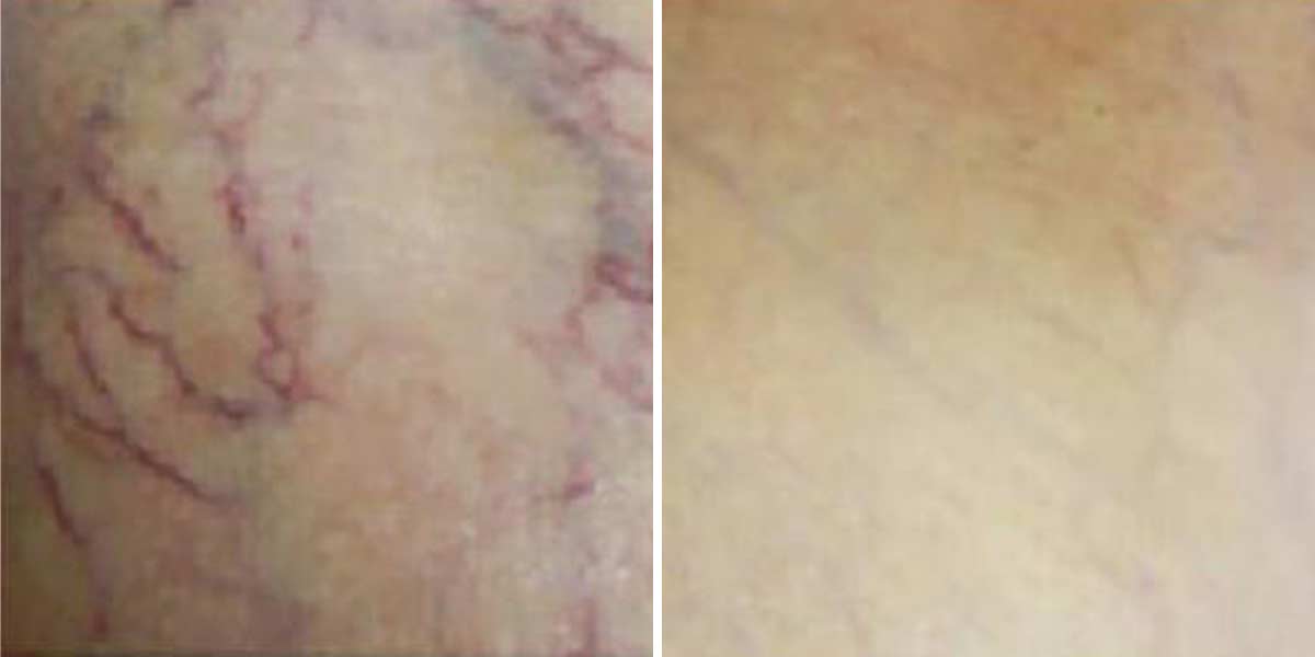 Before-After-04