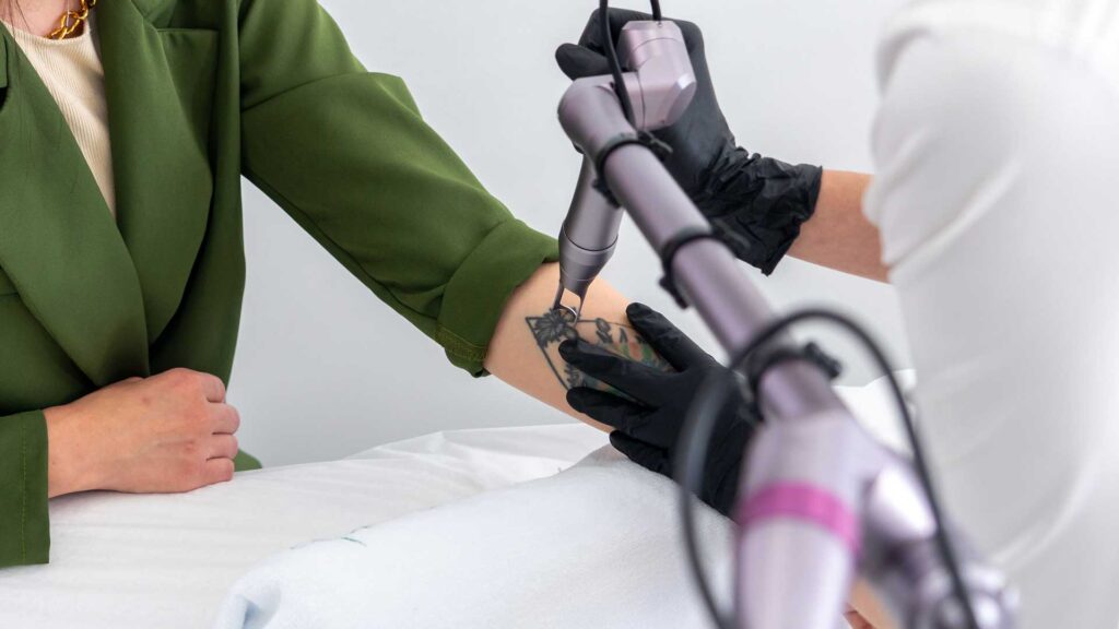 Selecting the best Tattoo Removal Machine