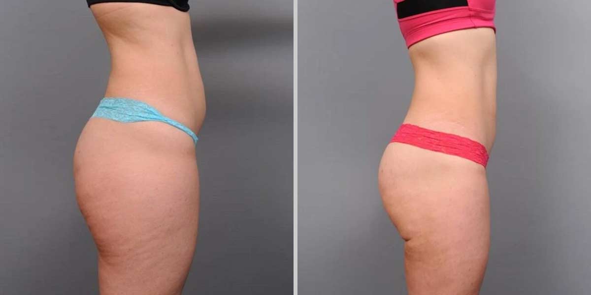 before-after-02