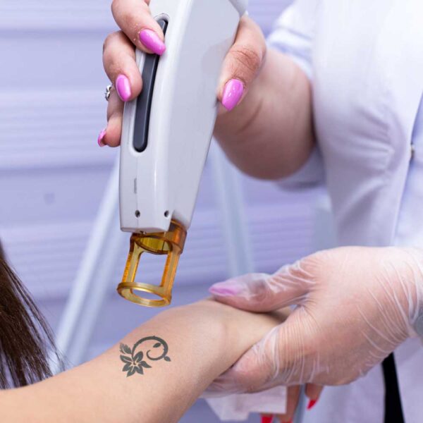 VTCT LEVEL 5: Laser Tattoo Removal