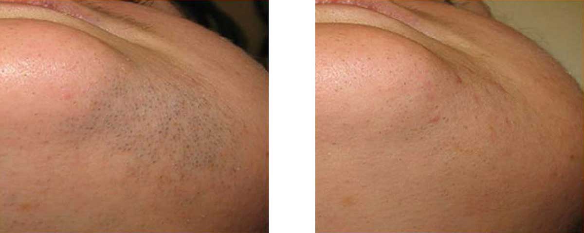 Before-After-01