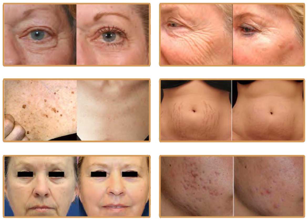 Before-After