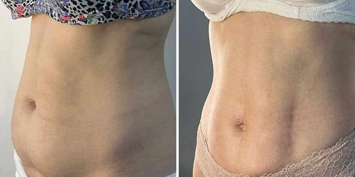 Before-After-01