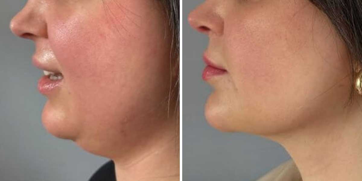 Before-After-02
